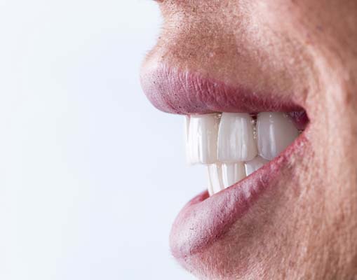 Implant Supported Dentures Shoreline, WA