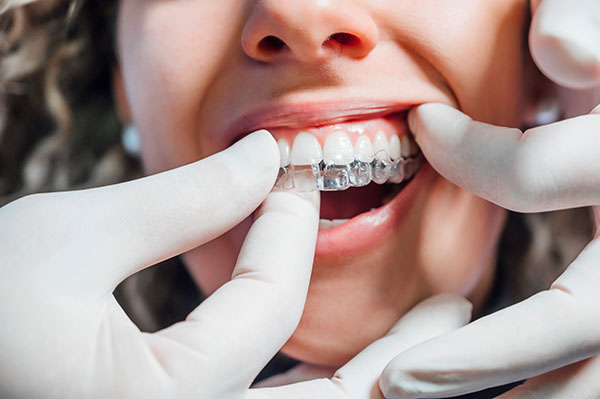 Invisalign Is Effective for Less Complex Orthodontic Cases from Gentling Smiles in Shoreline, WA