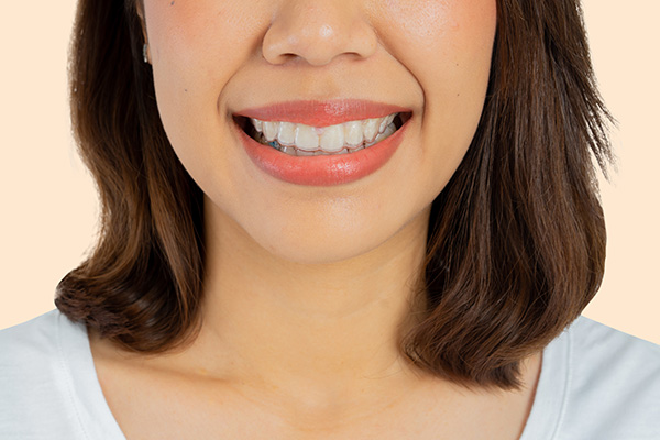Invisalign Teeth Straightening is More Comfortable than Braces from Gentling Smiles in Shoreline, WA